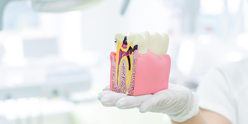 Entzündete Zähne erhalten: Wurzelbehandlung in Viersen